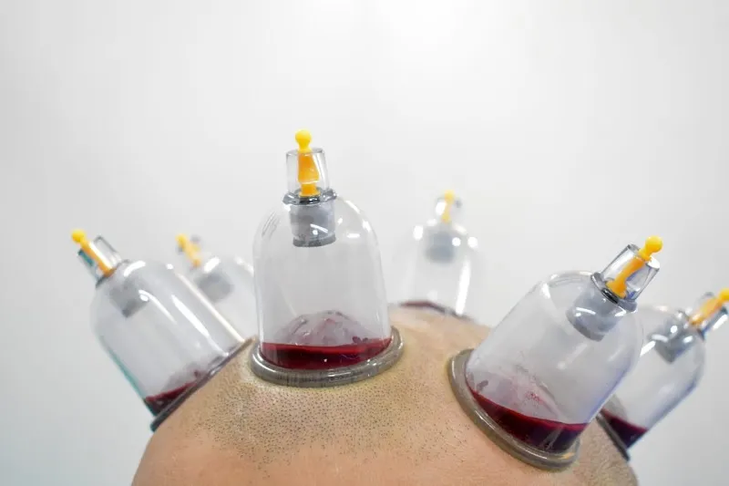 Life Cure Hijama Center (Cupping Therapy Center)