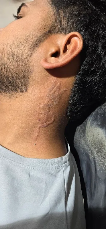 Tattoo Laser Removal