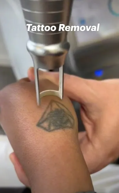 Tattoo Laser Removal