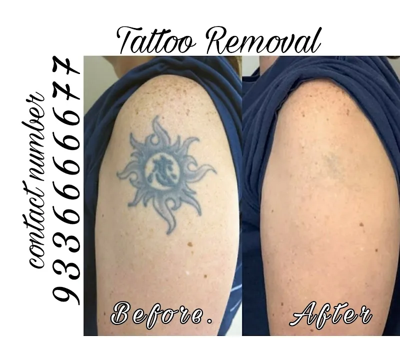 Menders Tattoo Removal & piercing lucknow