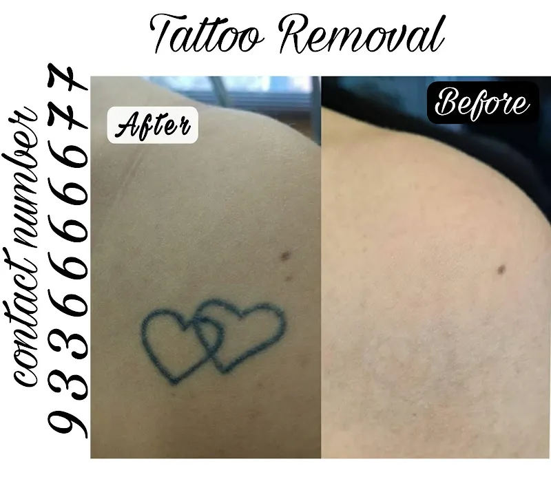 Menders Tattoo Removal & piercing lucknow