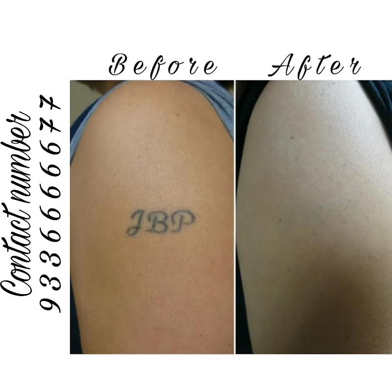 Magnet tattoo removal & Body piercing
