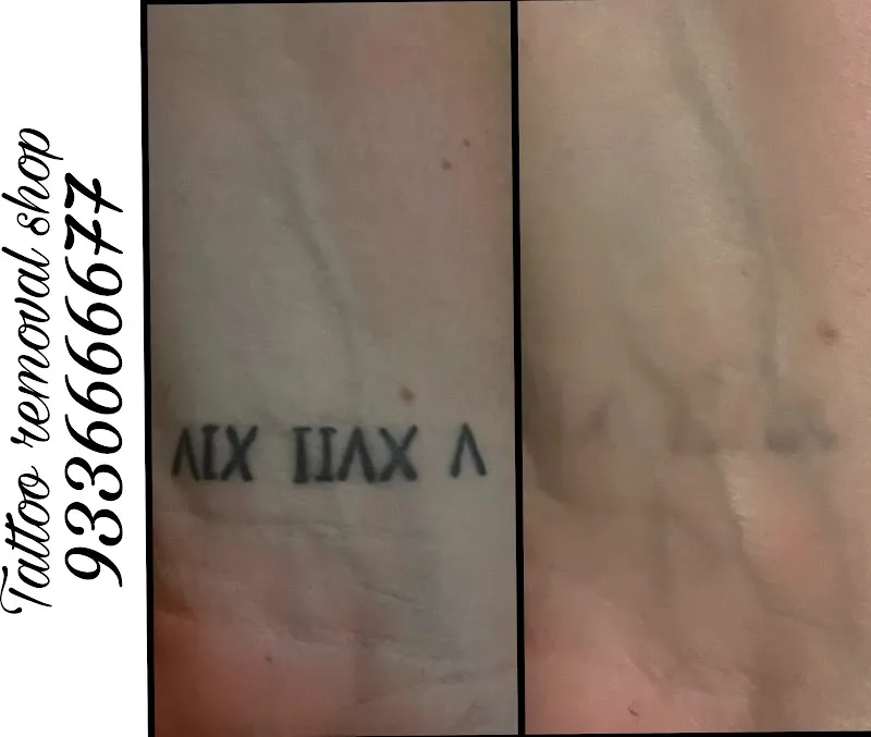 Magnet tattoo removal & Body piercing