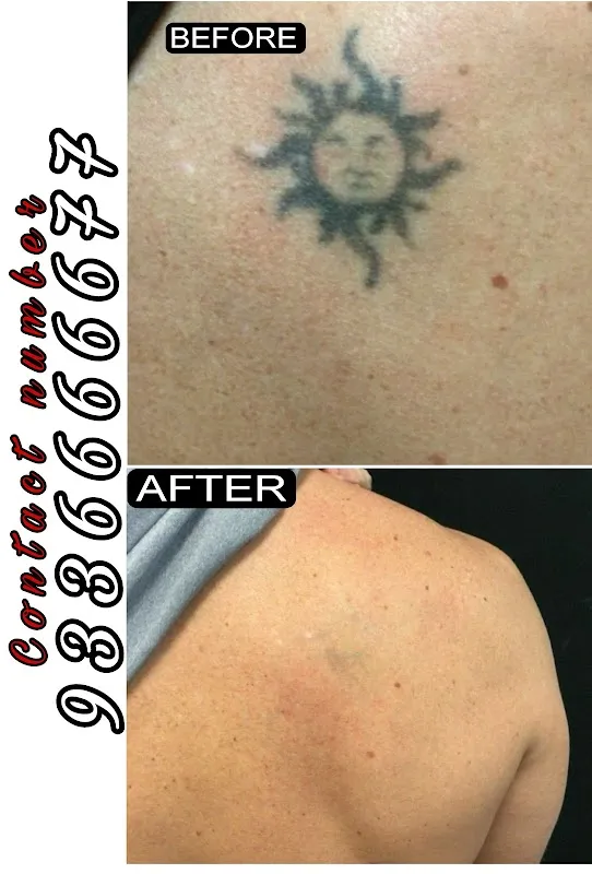 Magnet tattoo removal & Body piercing