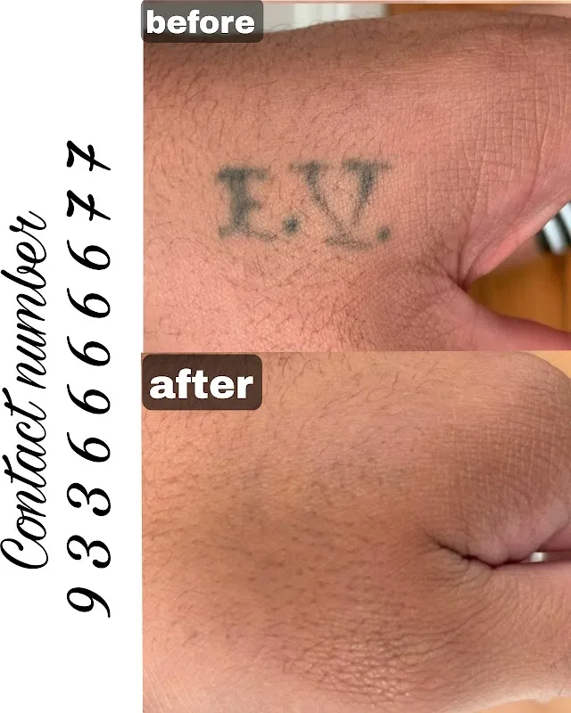 Magnet tattoo removal & Body piercing