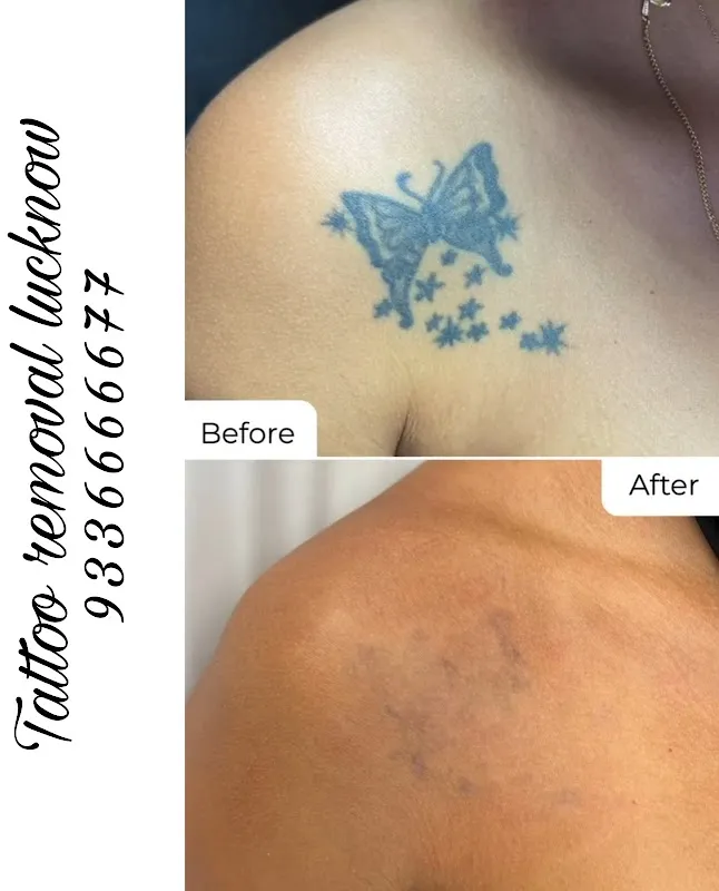 Magnet tattoo removal & Body piercing