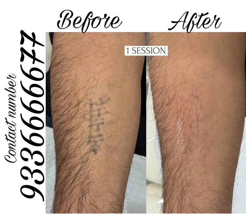Magnet tattoo removal & Body piercing