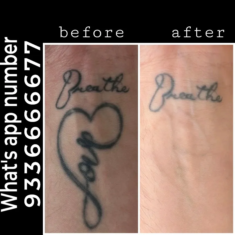 Magnet tattoo removal & Body piercing